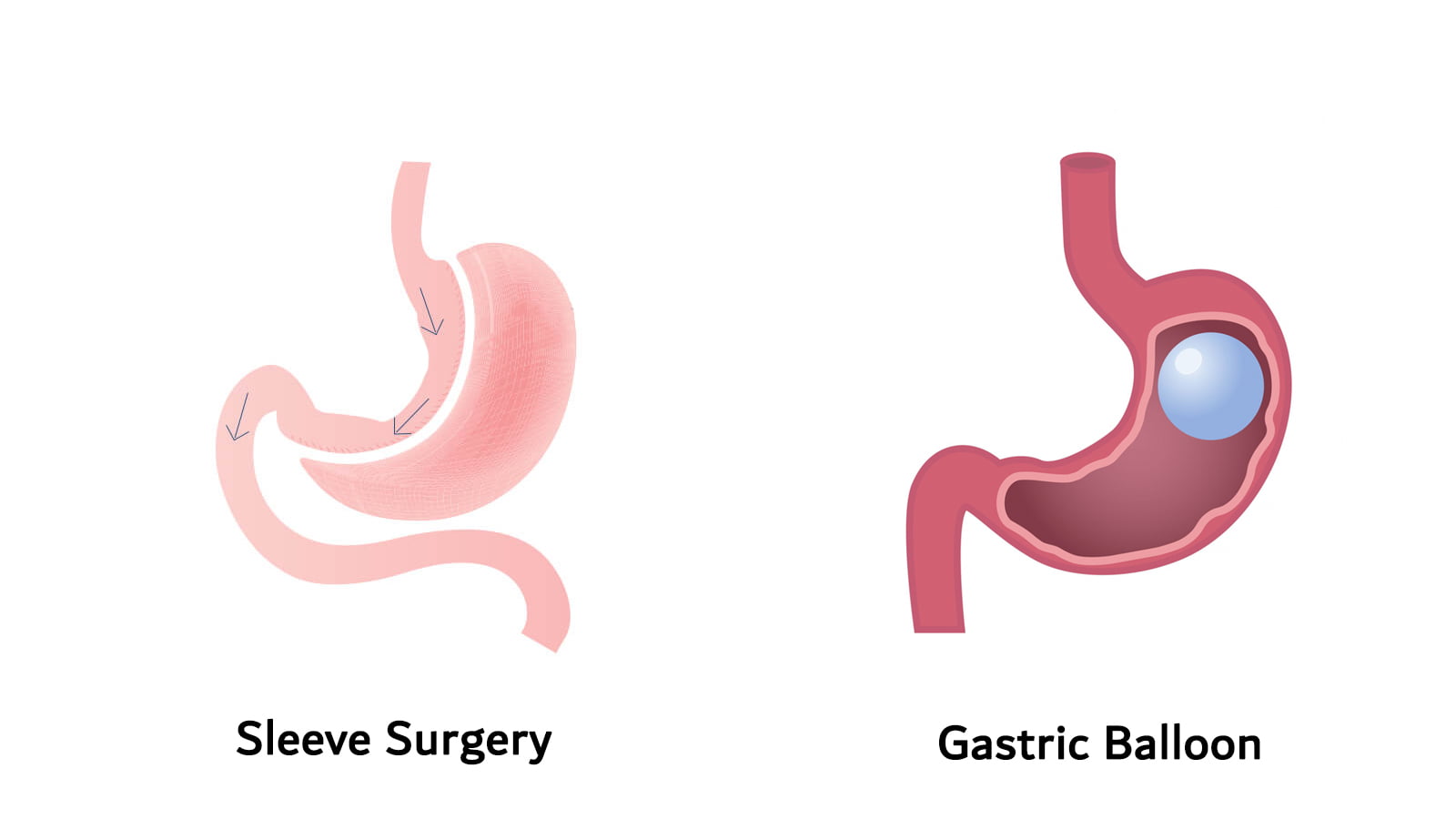 بالون معده یا اسلیو معده