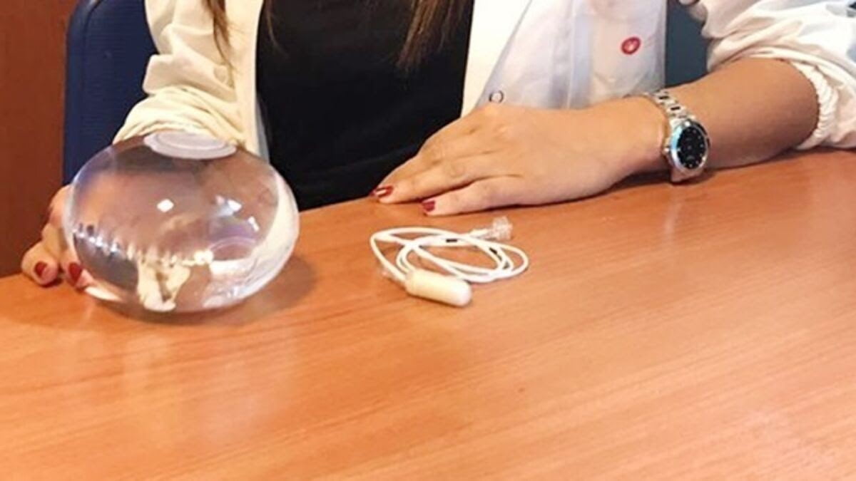 نحوه قرار دادن بالون معده