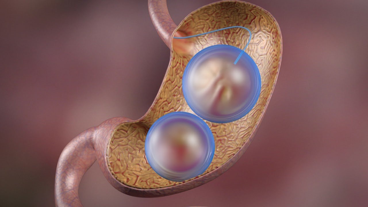 نکات حیاتی قبل از گذاشتن بالون معده