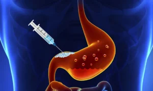 بوتاکس معده در تهران – راهنمای کامل + هزینه و مزایا 2 بوتاکس معده