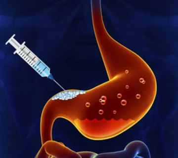 بوتاکس معده در تهران – راهنمای کامل + هزینه و مزایا 9 بوتاکس معده