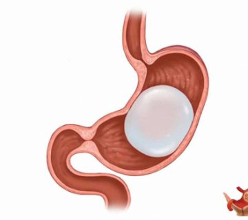 چه کسانی واجد شرایط بالون معده هستند؟ 12 بالن معده