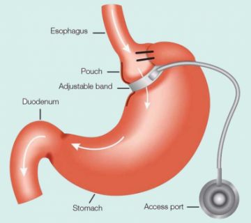 تفاوت بالون معده و باند معده در چیست؟ 13 تفاوت بین بالون معده و باند معده