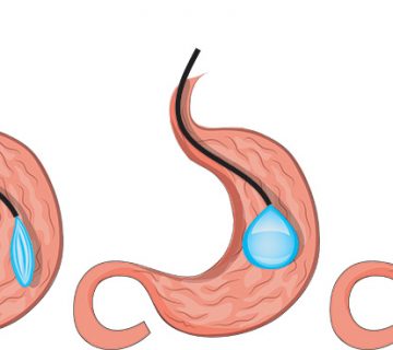 آیا بالون معده برای من مفید است؟ 14 آیا بالون معده برای من مفید است ؟