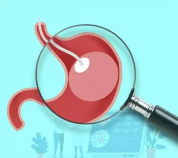 بالون معده و صفر تا 100 عوارض احتمالی آن 12 عوارص و خطرات احتمالی بالون معده