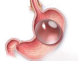 ترکیدن بالن معده، 12 روش جلوگیری از ترکیدن بالن معده 7 ترکیدن بالن معده