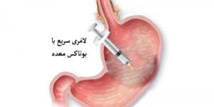 بوتاکس معده در تهران – راهنمای کامل + هزینه و مزایا 2 عمل بوتاکس معده در تهران