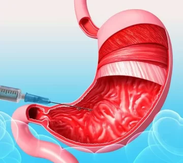 هزینه بوتاکس معده در تهران 1404: روشی نوین برای کاهش وزن 7 لاغری بوتاکس معده