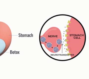 تجربه بوتاکس معده در سال 1404 چه بوده است؟ 7 تجربه بوتاکس معده
